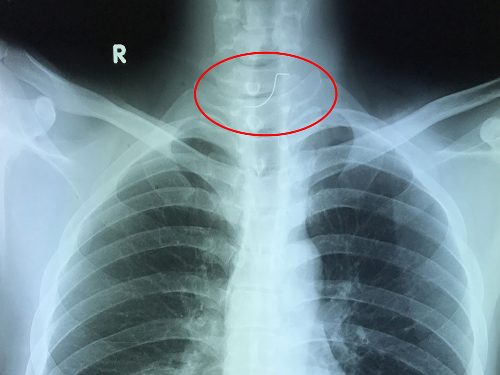 Rách thực quản - Hình ảnh minh họa